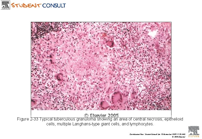 Figure 2 -33 Typical tuberculous granuloma showing an area of central necrosis, epithelioid cells,