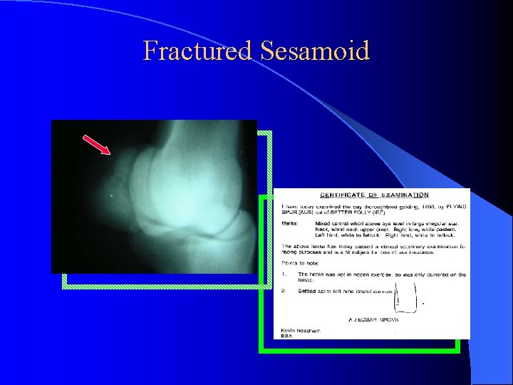 Fractured Sesamoid 