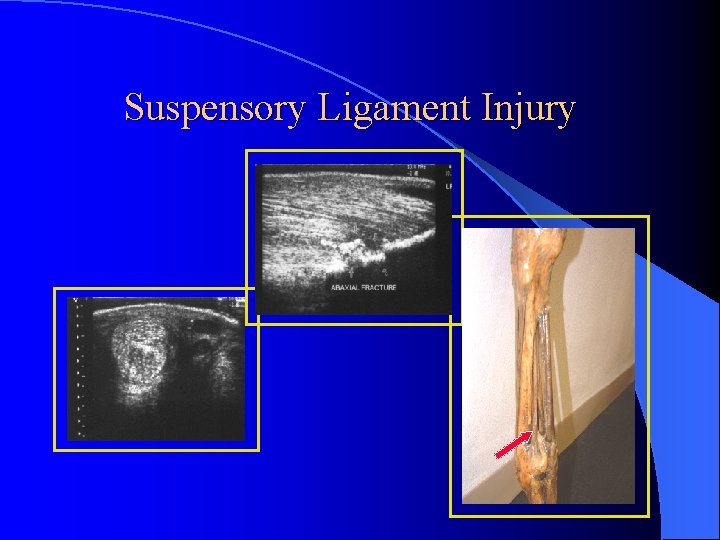 Suspensory Ligament Injury 