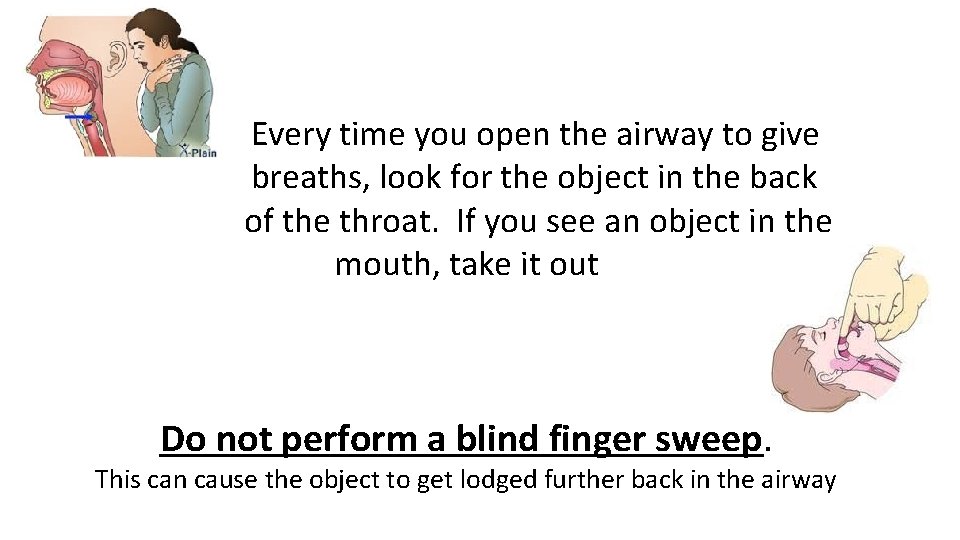 Every time you open the airway to give breaths, look for the object in