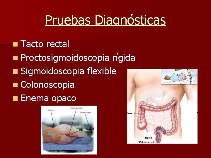 Pruebas Diagnósticas n Tacto rectal n Proctosigmoidoscopia rígida n Sigmoidoscopia flexible n Colonoscopia n