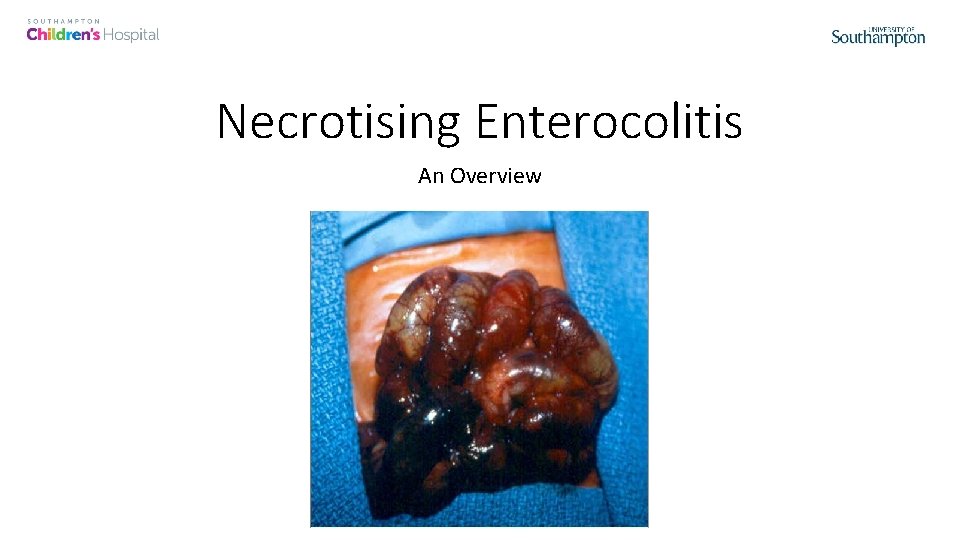 Necrotising Enterocolitis An Overview 