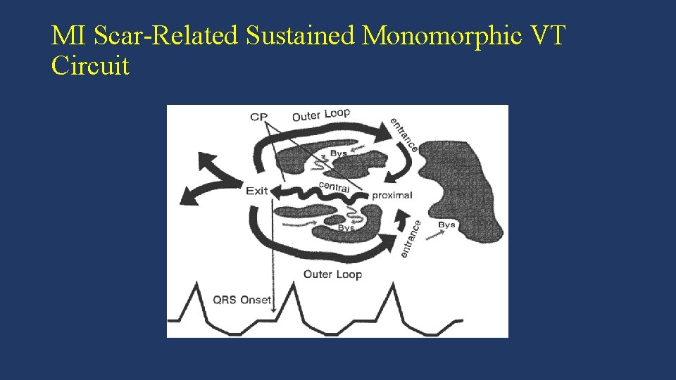 MI Scar-Related Sustained Monomorphic VT Circuit 