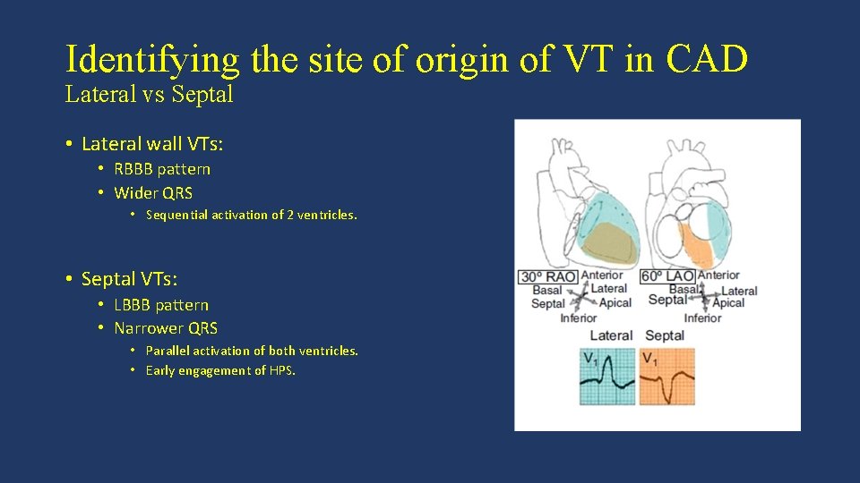 Identifying the site of origin of VT in CAD Lateral vs Septal • Lateral