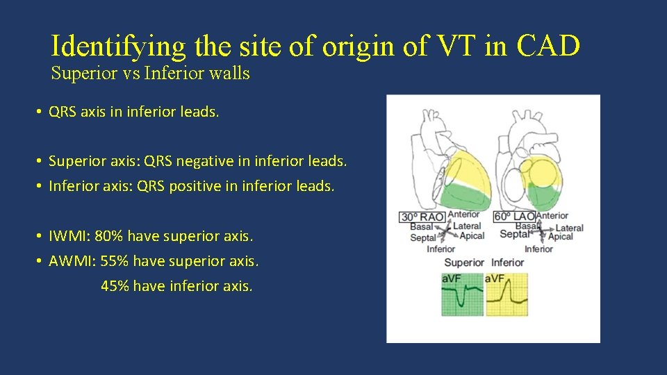 Identifying the site of origin of VT in CAD Superior vs Inferior walls •