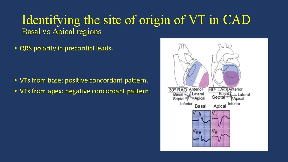 Identifying the site of origin of VT in CAD Basal vs Apical regions •
