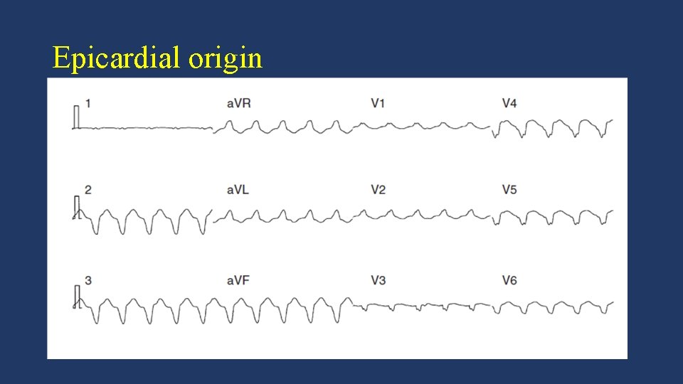 Epicardial origin • Rare in post MI VT, less than 2% of all cases.