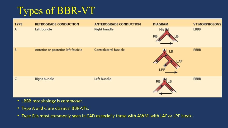 Types of BBR-VT • LBBB morphology is commoner. • Type A and C are