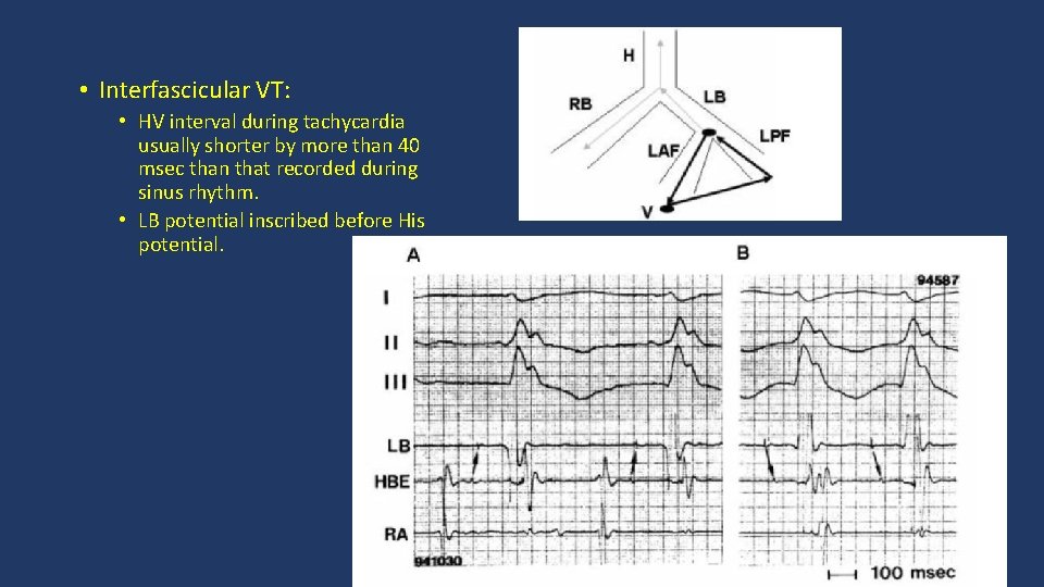  • Interfascicular VT: • HV interval during tachycardia usually shorter by more than