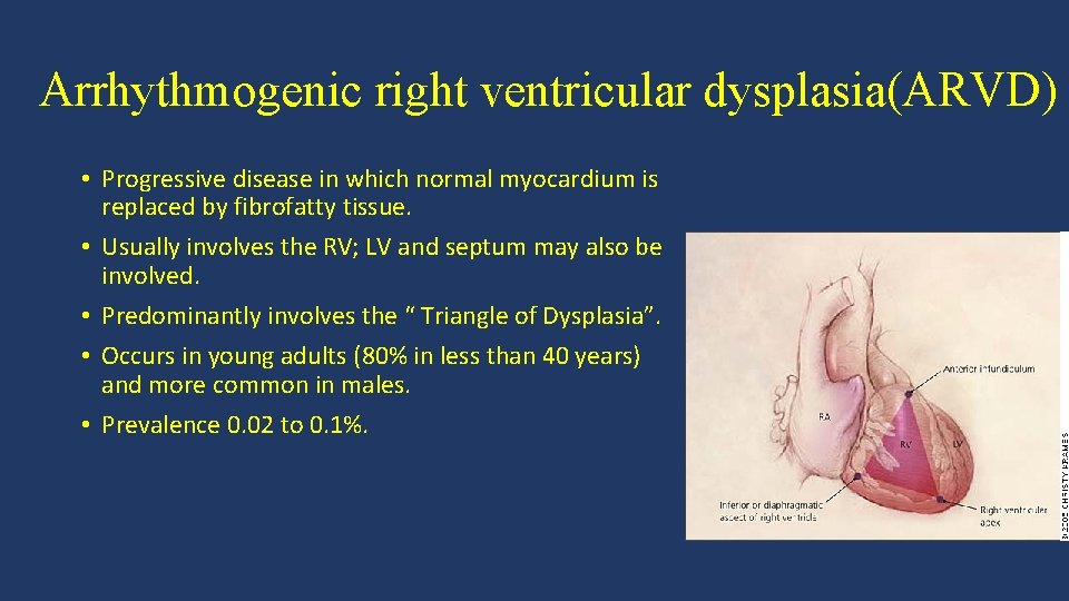 Arrhythmogenic right ventricular dysplasia(ARVD) • Progressive disease in which normal myocardium is replaced by