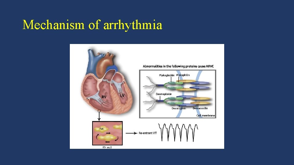 Mechanism of arrhythmia 