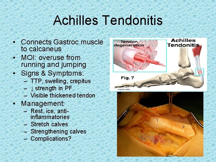 Achilles Tendonitis • Connects Gastroc muscle to calcaneus • MOI: overuse from running and Achilles Tendonitis • Connects Gastroc muscle to calcaneus • MOI: overuse from running and