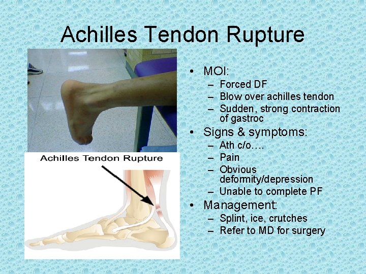 Achilles Tendon Rupture • MOI: – Forced DF – Blow over achilles tendon – Achilles Tendon Rupture • MOI: – Forced DF – Blow over achilles tendon –