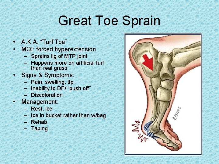 Great Toe Sprain • A. K. A. “Turf Toe” • MOI: forced hyperextension – Great Toe Sprain • A. K. A. “Turf Toe” • MOI: forced hyperextension –