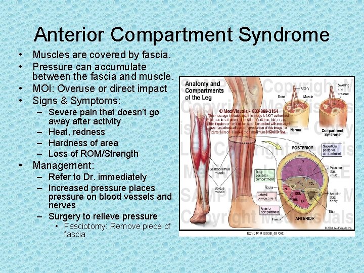 Anterior Compartment Syndrome • Muscles are covered by fascia. • Pressure can accumulate between Anterior Compartment Syndrome • Muscles are covered by fascia. • Pressure can accumulate between