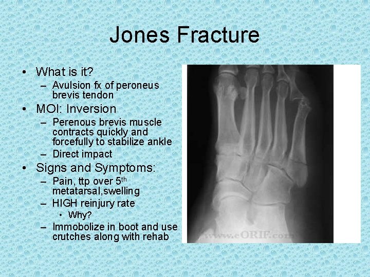 Jones Fracture • What is it? – Avulsion fx of peroneus brevis tendon • Jones Fracture • What is it? – Avulsion fx of peroneus brevis tendon •