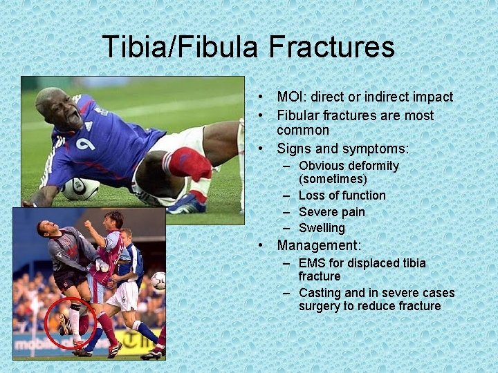 Tibia/Fibula Fractures • MOI: direct or indirect impact • Fibular fractures are most common Tibia/Fibula Fractures • MOI: direct or indirect impact • Fibular fractures are most common