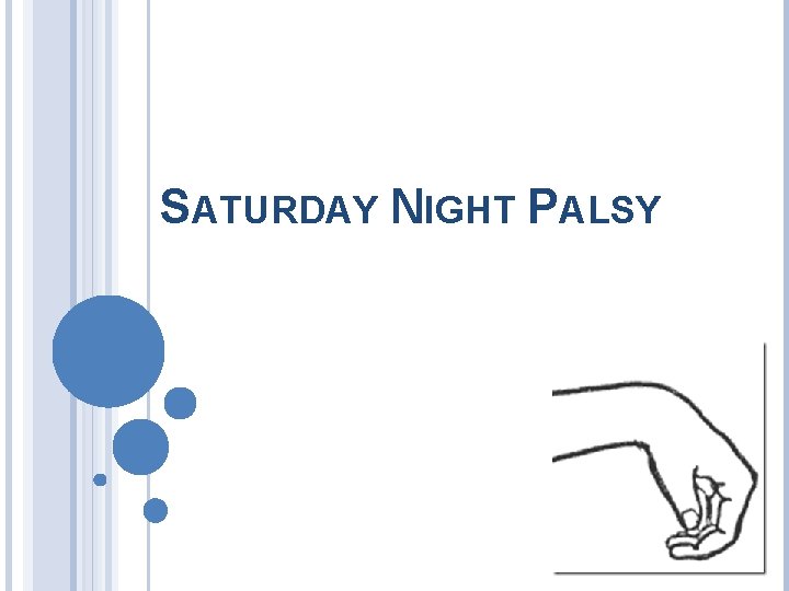 SATURDAY NIGHT PALSY 