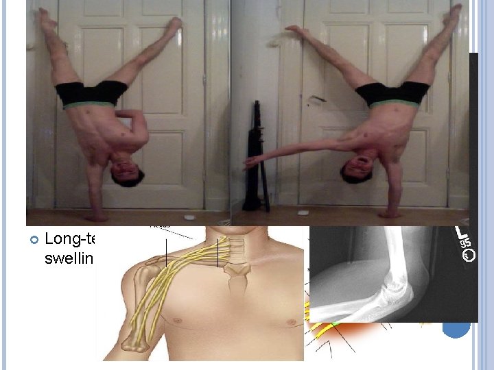 CAUSES Main causes of Saturday night palsy : Wrong sleeping (compression on radial nerve)