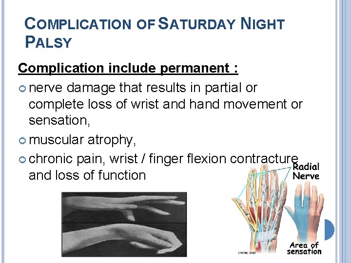 COMPLICATION OF SATURDAY NIGHT PALSY Complication include permanent : nerve damage that results in