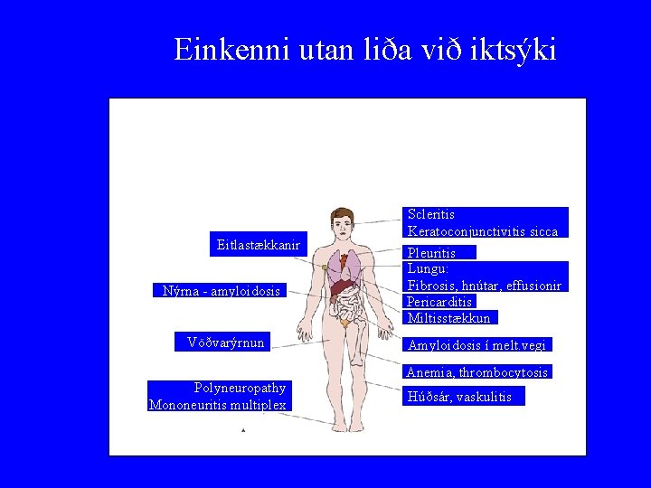 Einkenni utan liða við iktsýki Eitlastækkanir Nýrna - amyloidosis Vöðvarýrnun Polyneuropathy Mononeuritis multiplex Scleritis