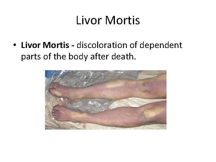 Livor Mortis • Livor Mortis - discoloration of dependent parts of the body after