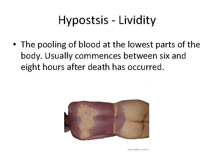 Hypostsis - Lividity • The pooling of blood at the lowest parts of the