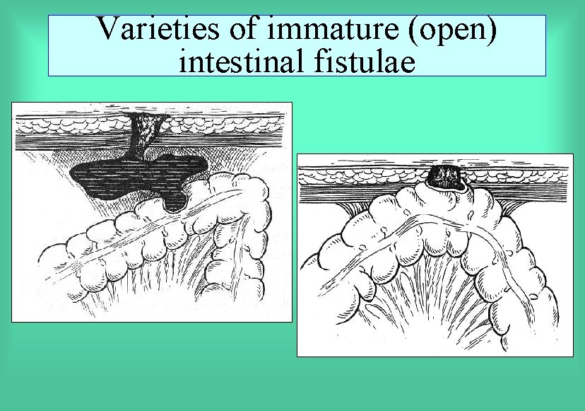 Varieties of immature (open) intestinal fistulae 