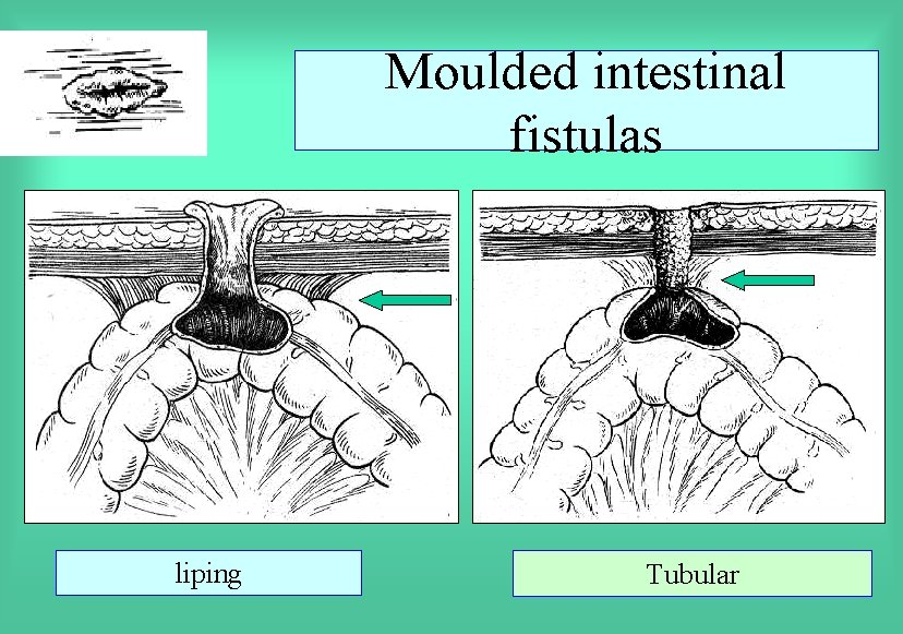 Moulded intestinal fistulas liping Tubular 
