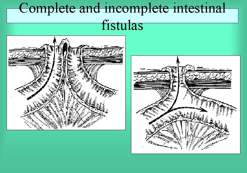 Complete and incomplete intestinal fistulas 