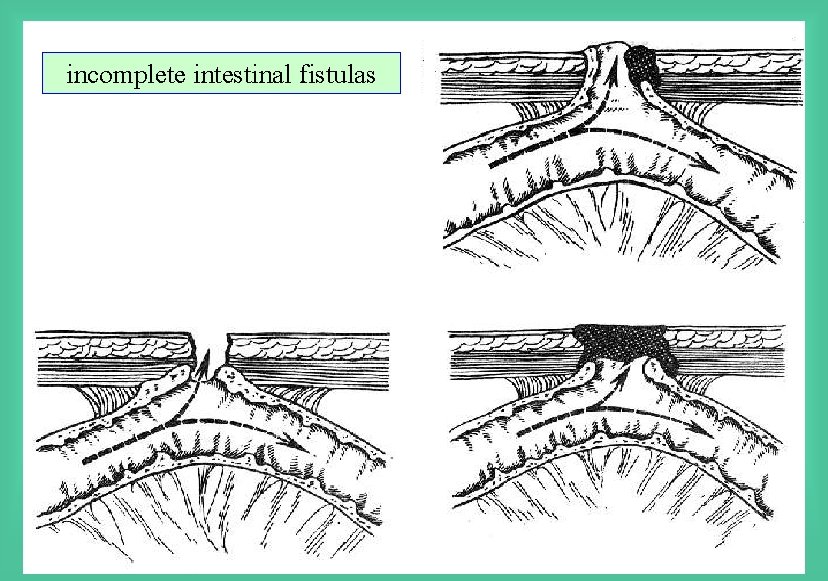 incomplete intestinal fistulas 