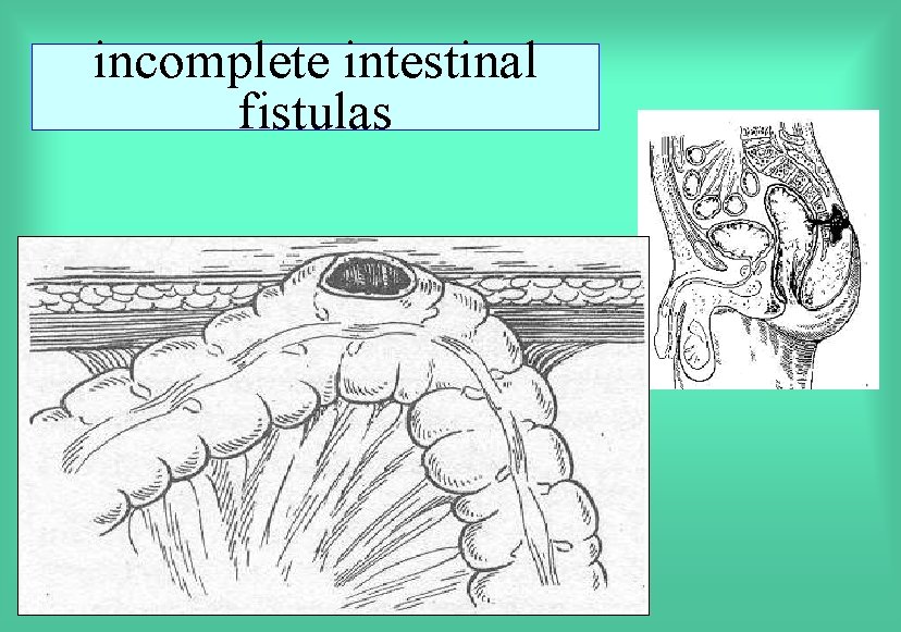incomplete intestinal fistulas 