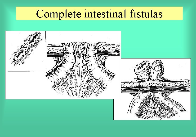 Complete intestinal fistulas 