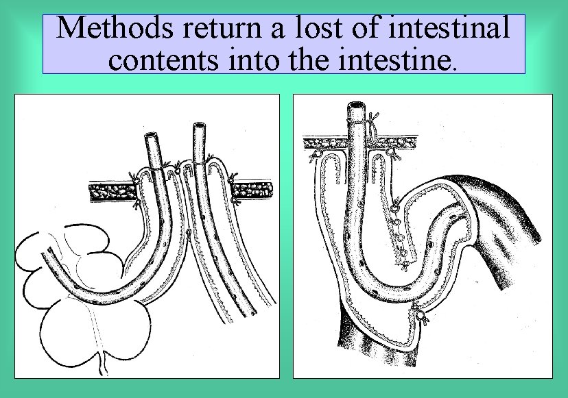 Methods return a lost of intestinal contents into the intestine. 