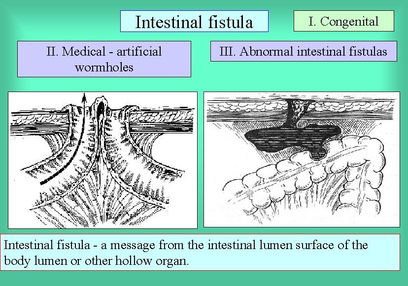 Intestinal fistula II. Medical - artificial wormholes I. Congenital III. Abnormal intestinal fistulas Intestinal