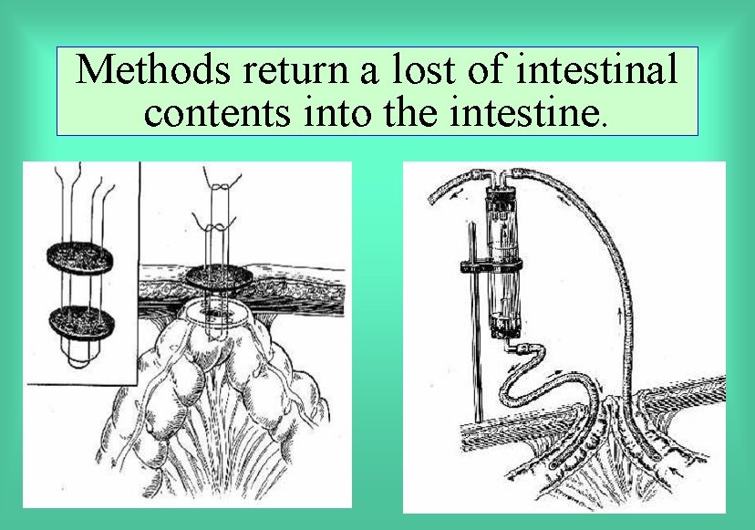 Methods return a lost of intestinal contents into the intestine. 