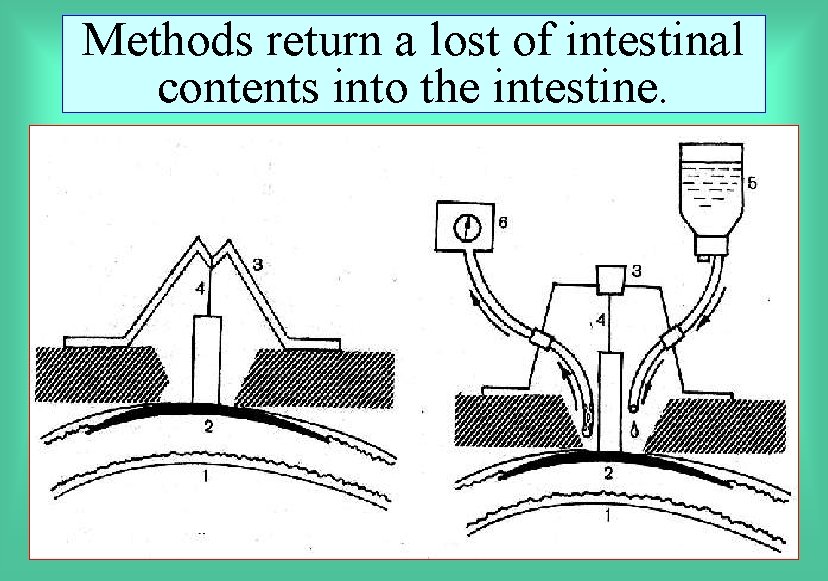 Methods return a lost of intestinal contents into the intestine. 