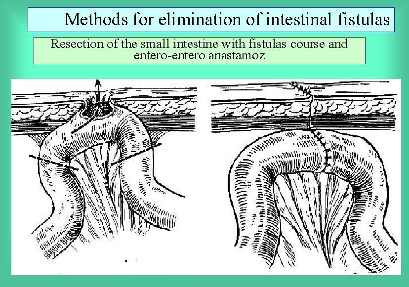 Methods for elimination of intestinal fistulas Resection of the small intestine with fistulas course