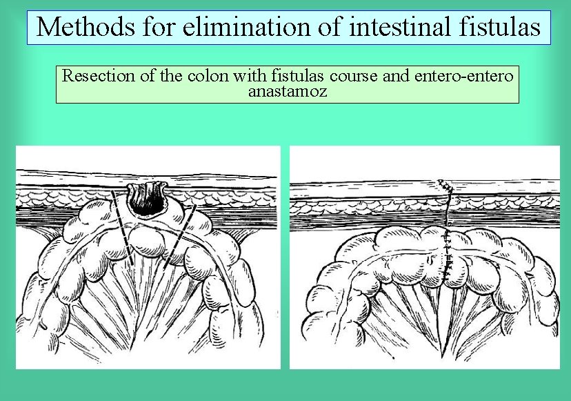Methods for elimination of intestinal fistulas Resection of the colon with fistulas course and