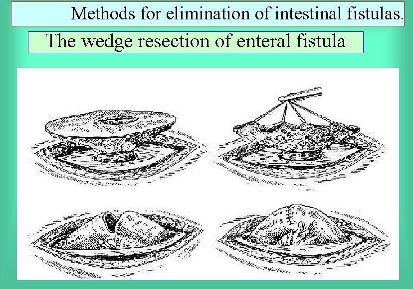 Methods for elimination of intestinal fistulas. The wedge resection of enteral fistula 