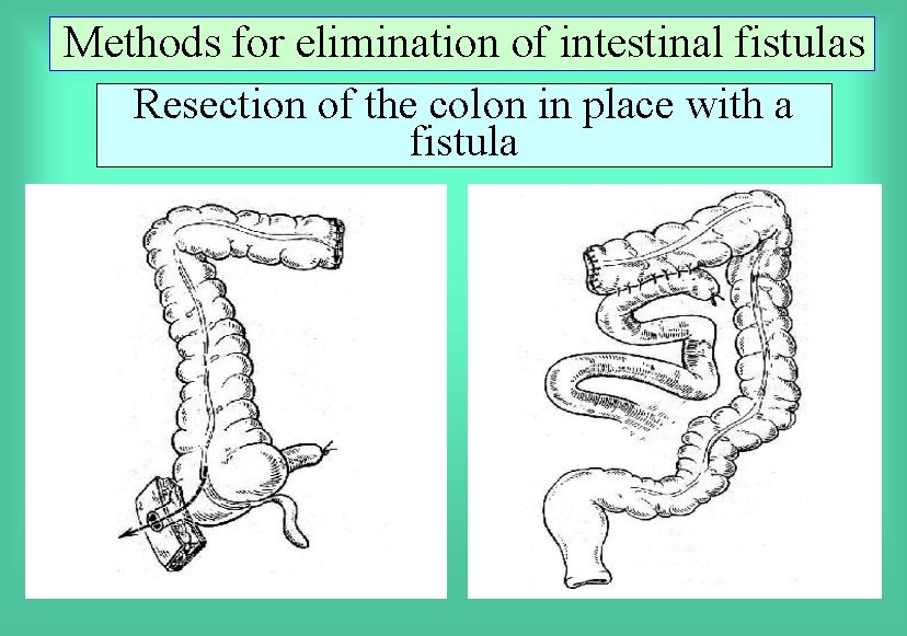 Methods for elimination of intestinal fistulas Resection of the colon in place with a