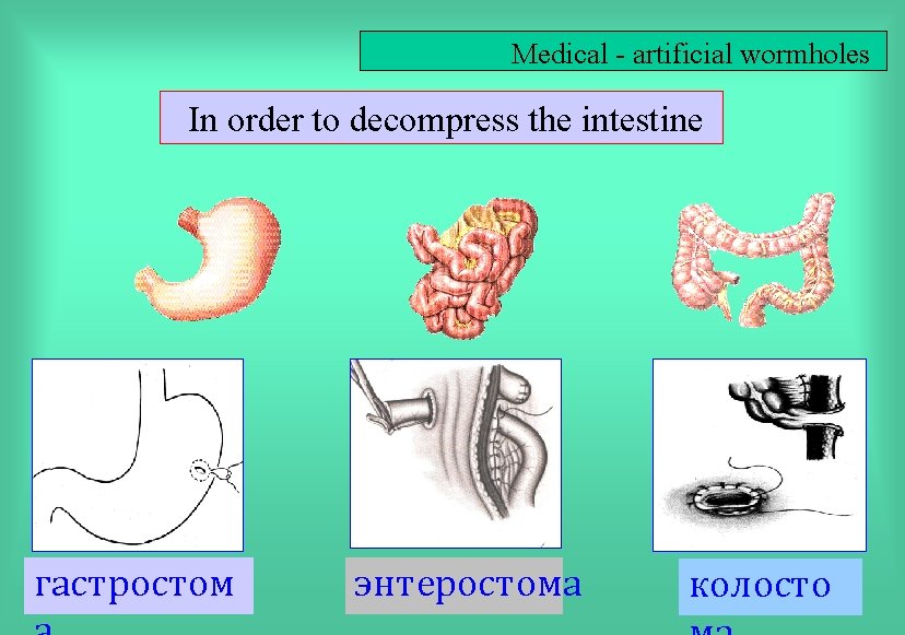 Medical - artificial wormholes In order to decompress the intestine гастростом энтеростома колосто 