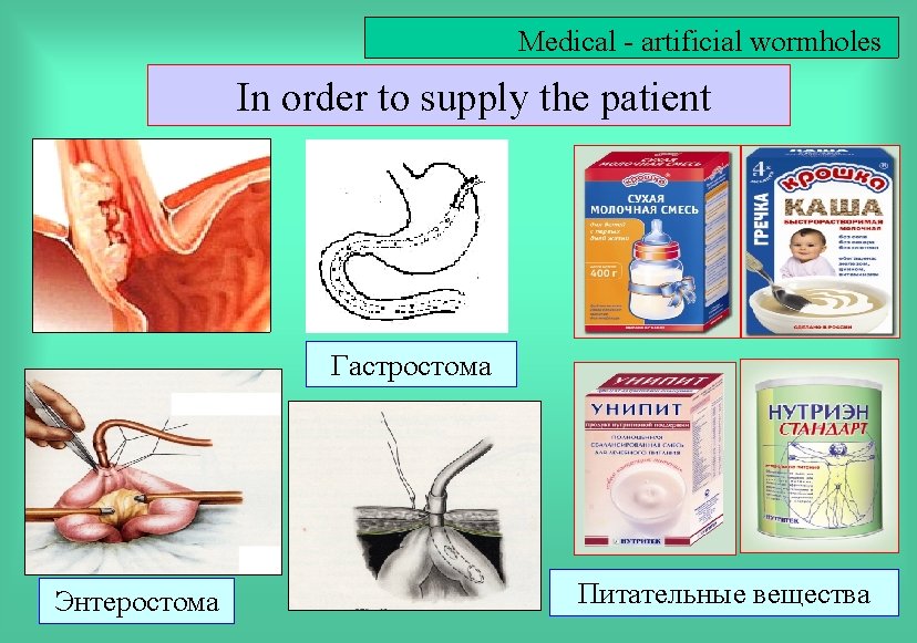 Medical - artificial wormholes In order to supply the patient Гастростома Энтеростома Питательные вещества
