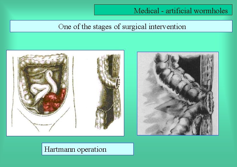 Medical - artificial wormholes One of the stages of surgical intervention Hartmann operation 
