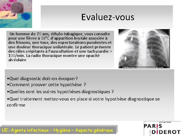 Evaluez-vous Un homme de 70 ans, éthylo-tabagique, vous consulte pour une fièvre à 39°C