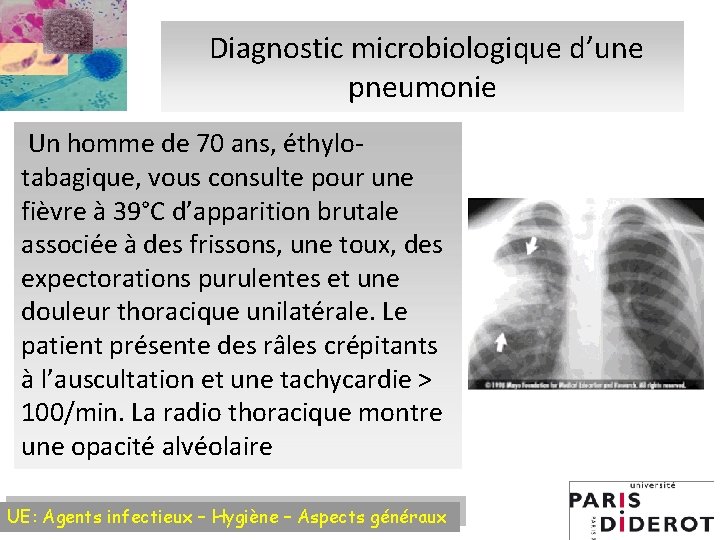 Diagnostic microbiologique d’une pneumonie Un homme de 70 ans, éthylotabagique, vous consulte pour une