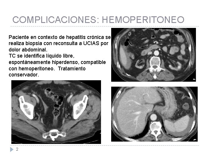 COMPLICACIONES: HEMOPERITONEO Paciente en contexto de hepatitis crónica se realiza biopsia con reconsulta a