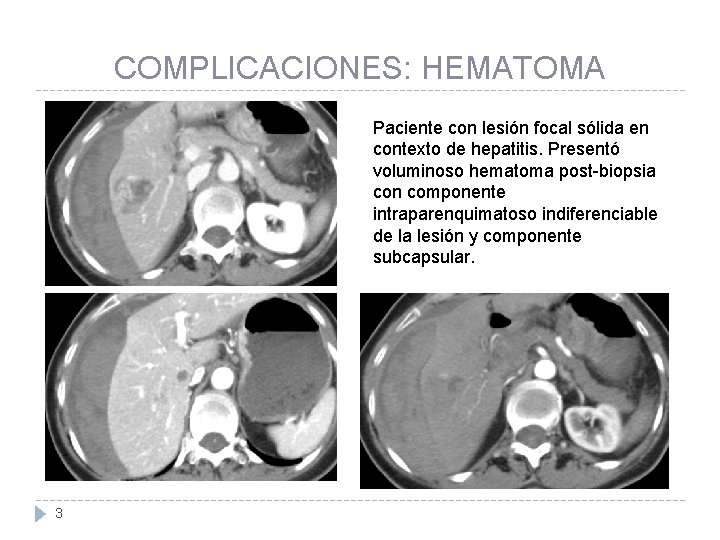 COMPLICACIONES: HEMATOMA Paciente con lesión focal sólida en contexto de hepatitis. Presentó voluminoso hematoma