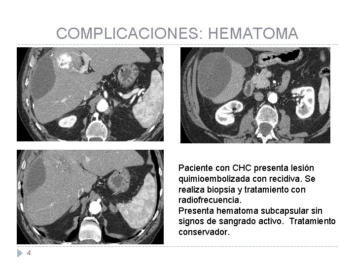 COMPLICACIONES: HEMATOMA Paciente con CHC presenta lesión quimioembolizada con recidiva. Se realiza biopsia y
