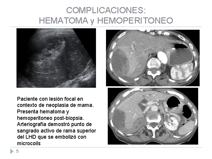 COMPLICACIONES: HEMATOMA y HEMOPERITONEO Paciente con lesión focal en contexto de neoplasia de mama.